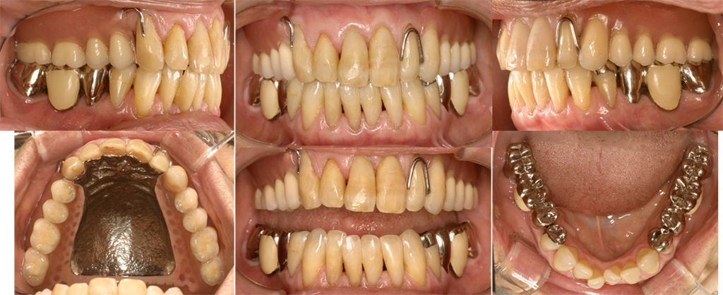 完成義歯の最終調整および完成