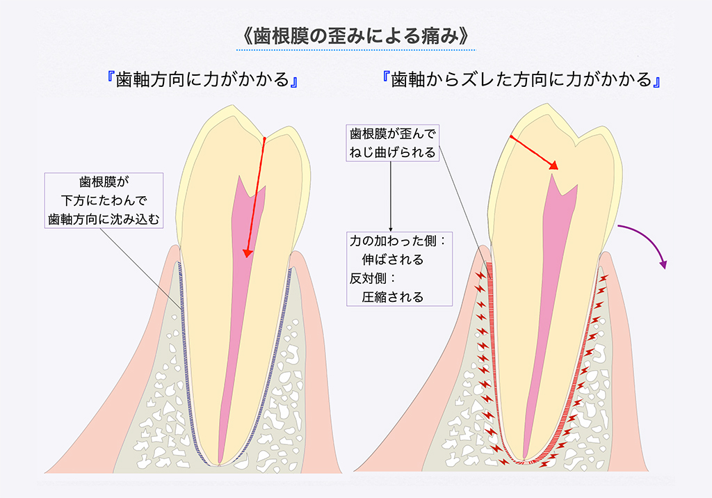 歯根膜の歪みによる接触時の痛み