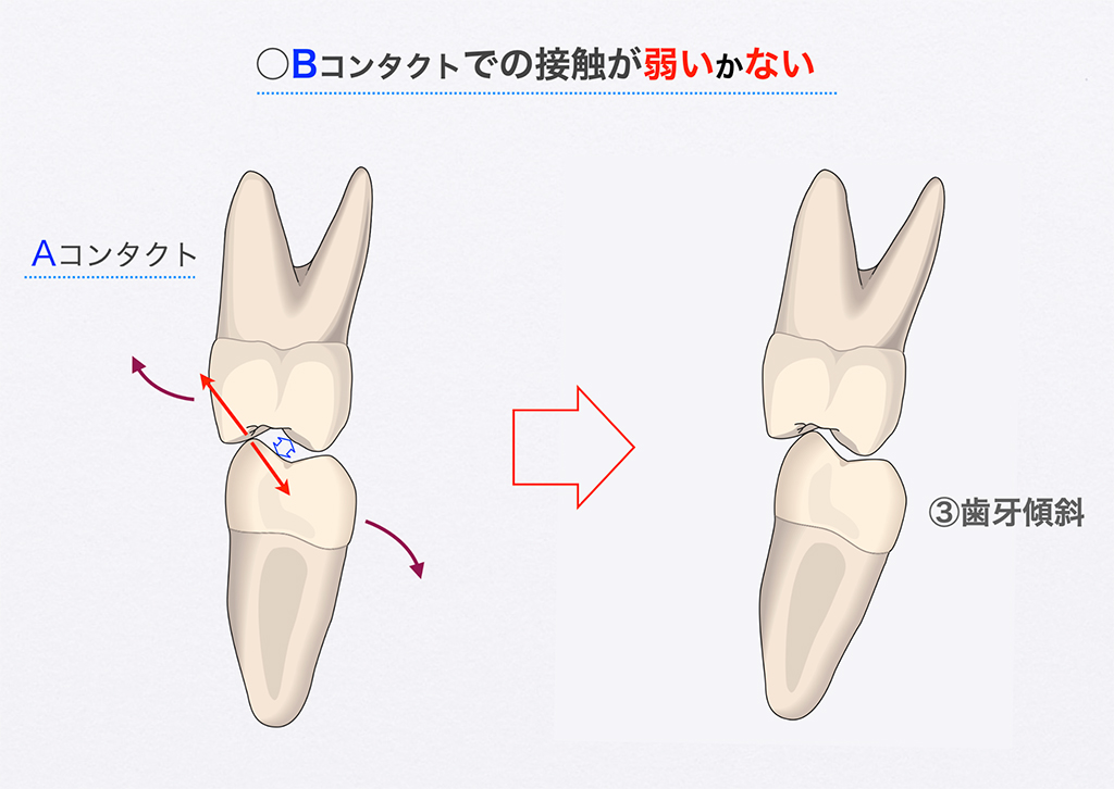 歯牙傾斜