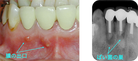 歯根端切除術の治療例