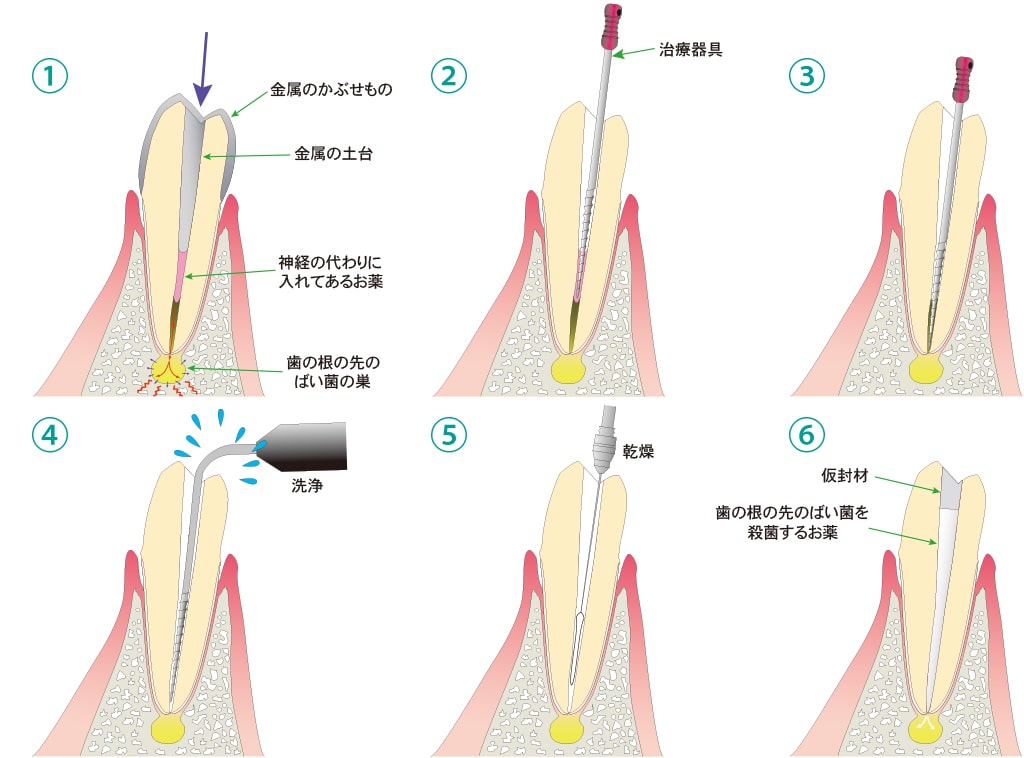 根尖性歯周炎の治療の流れ